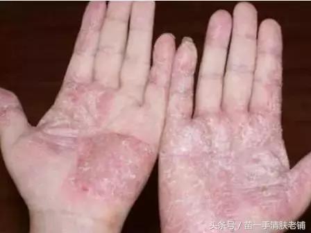 手癣可以吃梨瓜吗,天然润肤佳品